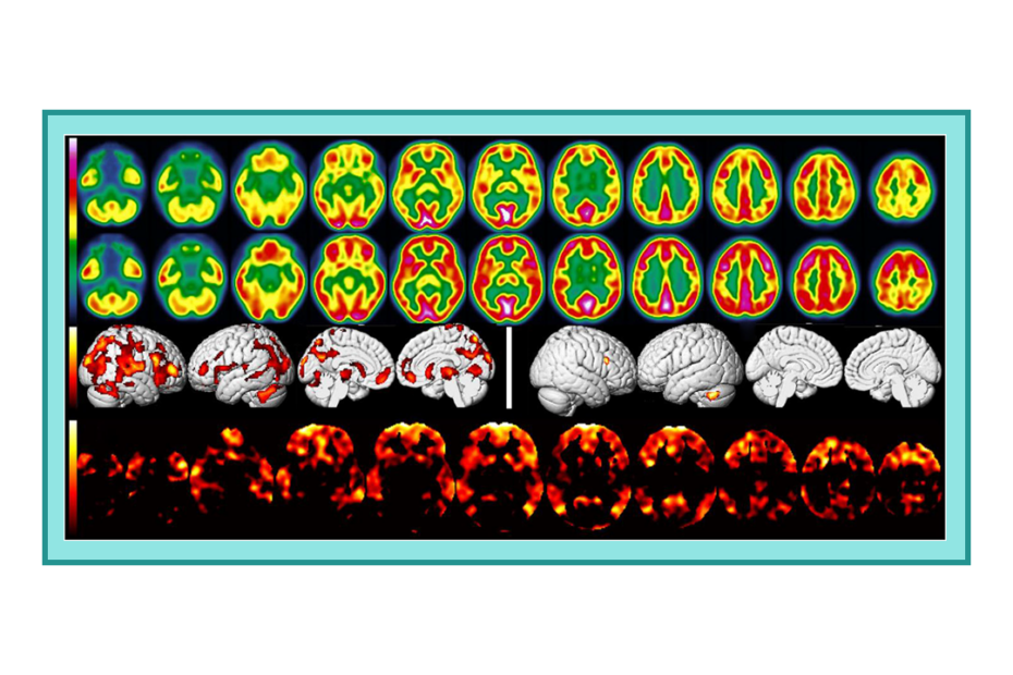 brain 18F-FDG