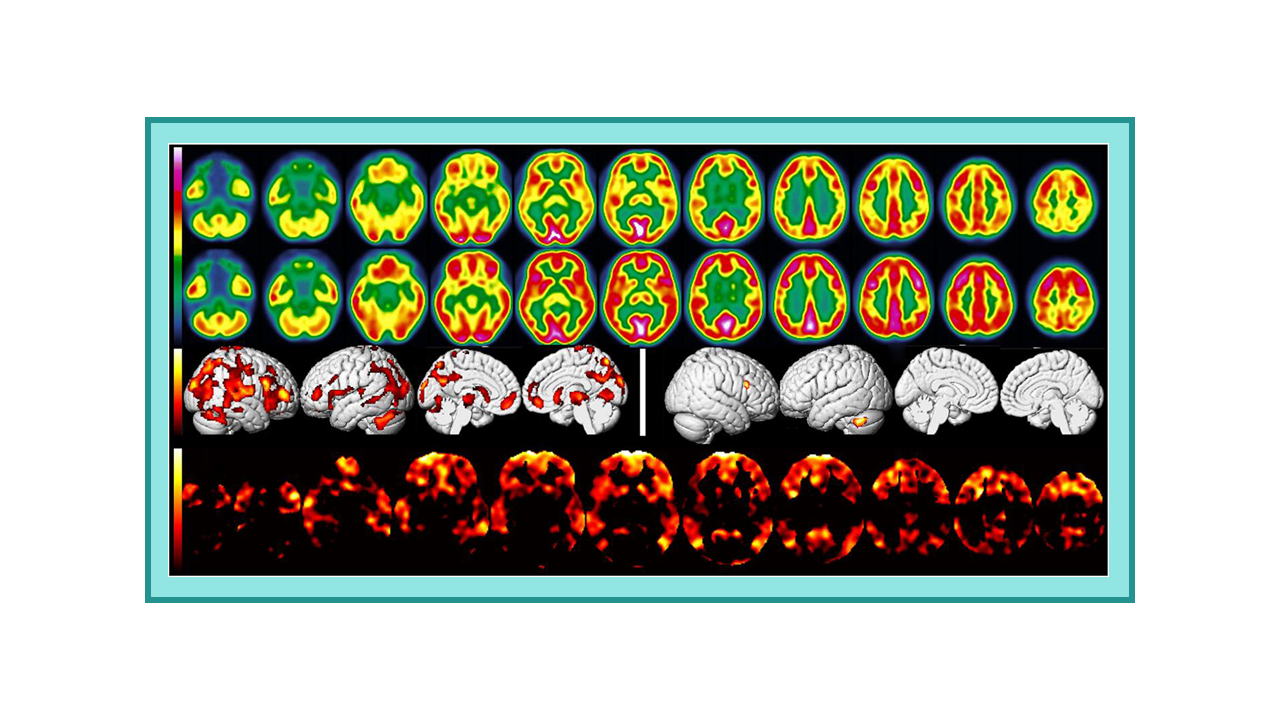 brain 18F-FDG