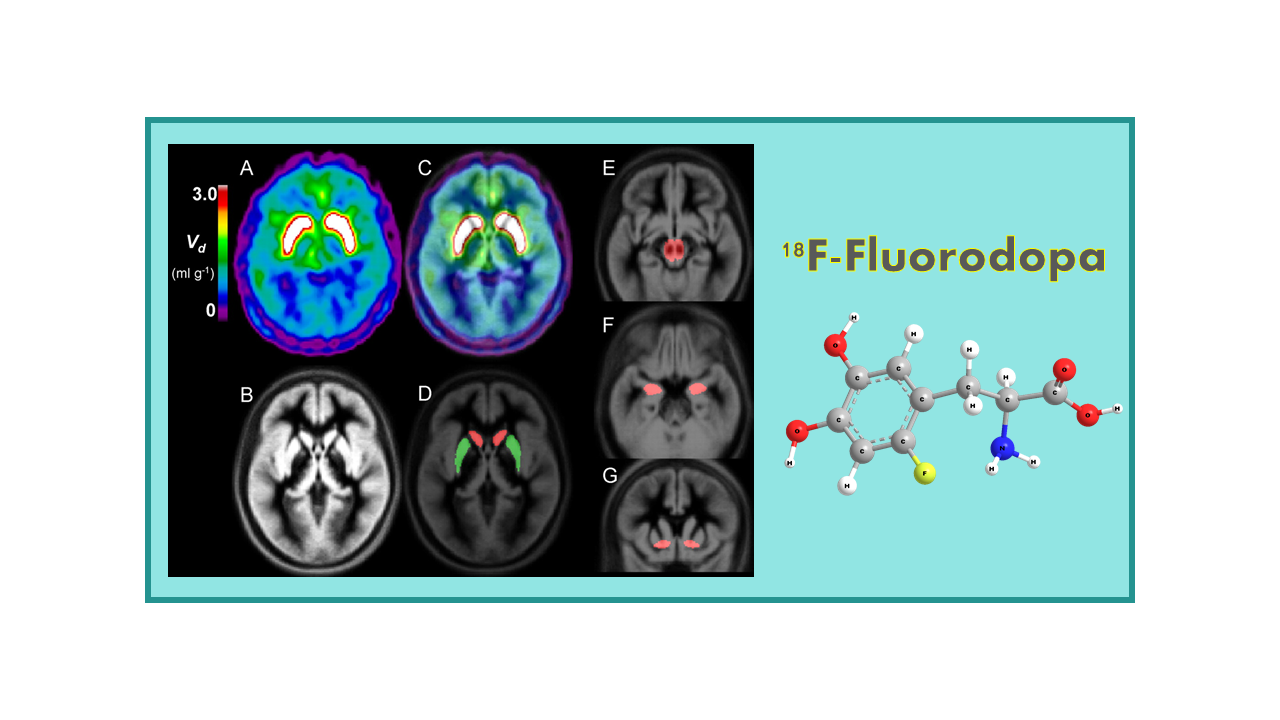 18F-Fluorodopa