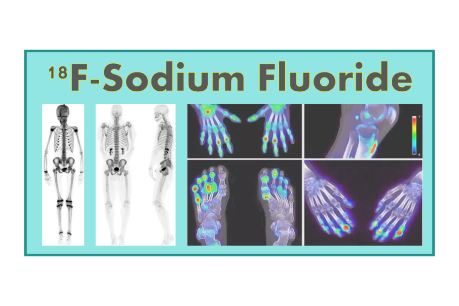 18F-Sodium Fluoride (NaF)