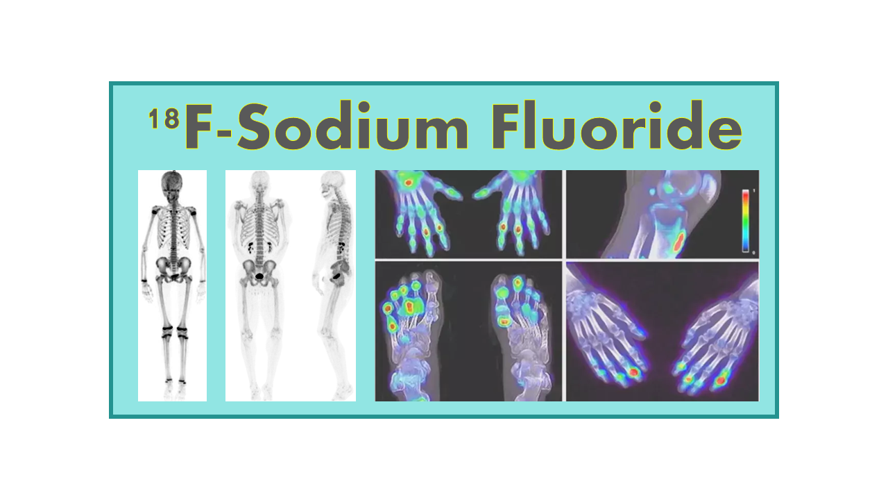 18F-Sodium Fluoride (NaF)