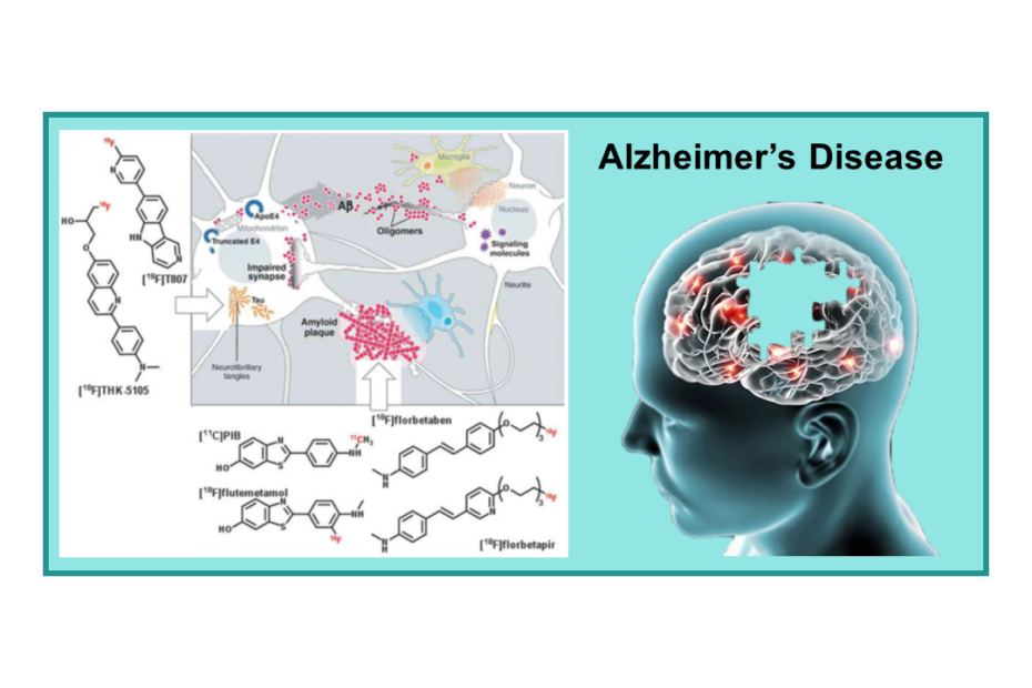 Alzheimer’s disease