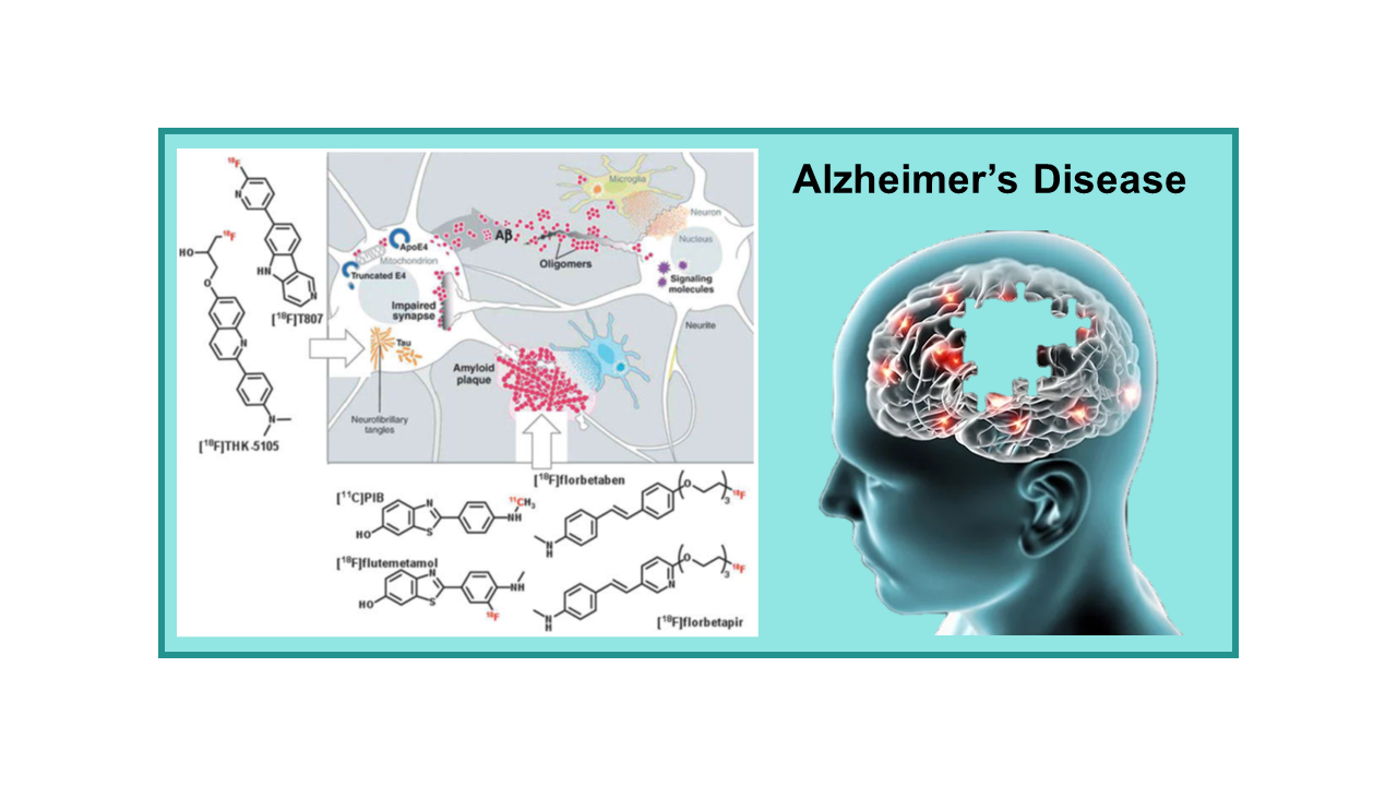 Alzheimer’s disease