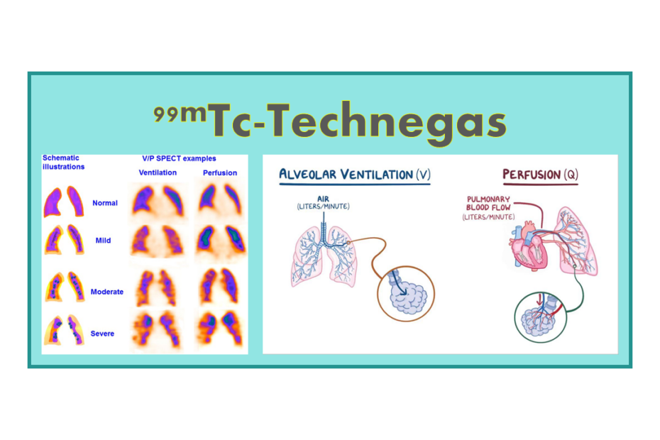 99mTc-Technegas